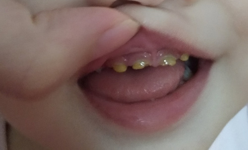 宝宝牙齿保健的3大妙招