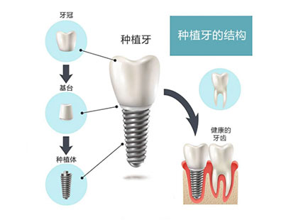 种植牙多少钱一颗？