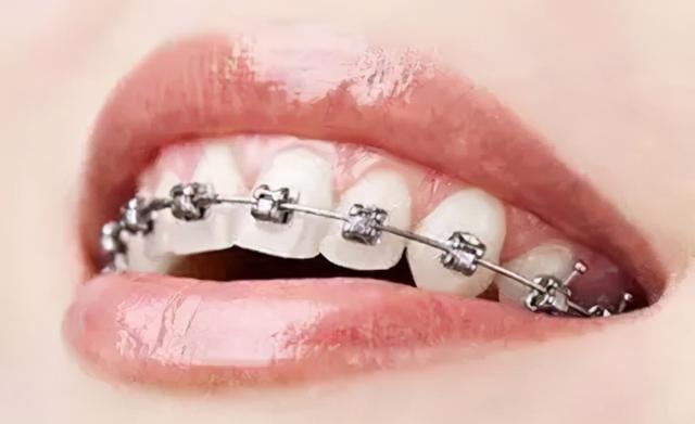 【正畸】牙齿矫正的最佳年龄是多少？