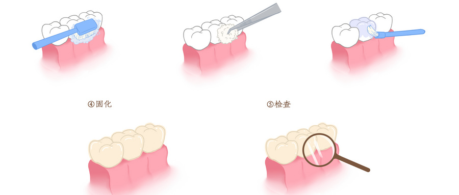 摄图网_401800107_wx_牙齿涂氟步骤科普插画（非企业商用）