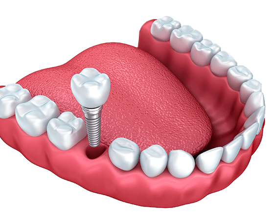 常规种牙流程是怎样的？