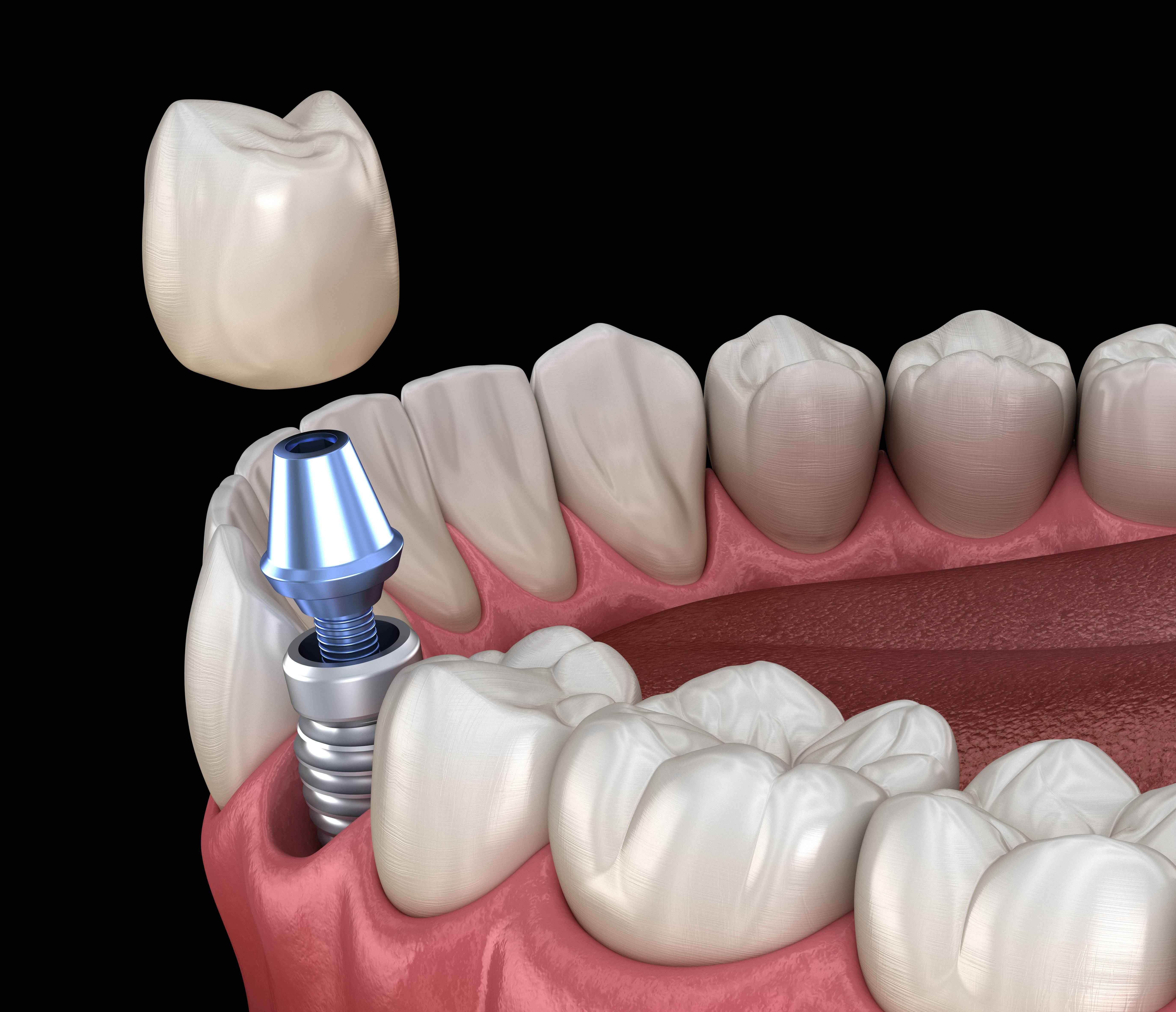 摄图网_502736300_种植体修复前磨牙人类牙齿和假牙概念的医学上准确的（非企业商用）(1)(1)