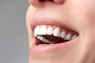 数码舌侧隐形正畸